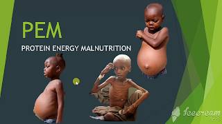 PEM protein energy malnutrition [upl. by Stilwell732]