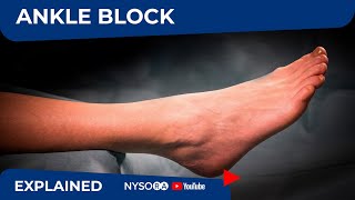 Regional Anesthesia UltrasoundGuided Ankle Block [upl. by Fleece]