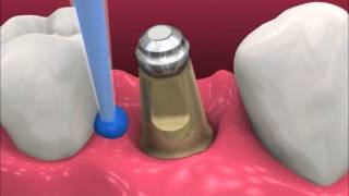 Smyl Manatee  Dental Implant Procedure [upl. by Chari]