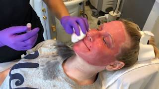 TRL Laser For A Dramatic Skin Rejuvenation [upl. by Pan]