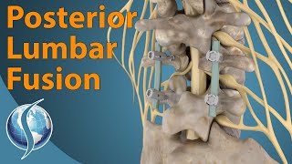 Posterior Lumbar Fusion [upl. by Nail]