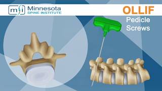 Minimally Invasive Oblique Lateral Lumbar Interbody Fusion OLLIF  the Minnesota Spine Institute [upl. by Alissa624]