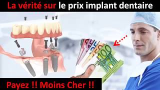 Prix implant dentaire  partie 1 [upl. by Ellehcit]