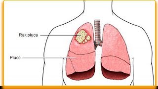 Jak się objawia rak płuc — objawy które powinieneś znać [upl. by Ytisahc829]