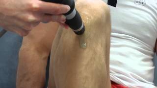 Osgood Schlatter shockwave [upl. by Monahan]