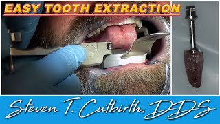 Easy Tooth Extraction  Dental Minute with Steven T Cutbirth DDS [upl. by Favien]