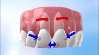 Discover how Invisalign works [upl. by Ryann]