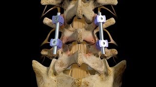 L45 Posterior Interbody Fusion [upl. by Diley696]