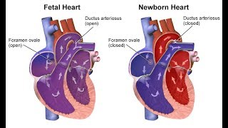 ¿Qué son las cardiopatías congénitas [upl. by Jacinthe]