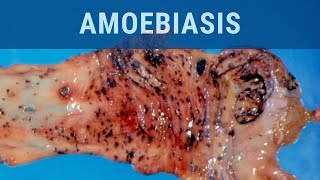 Amoebiasis  Pathology mini tutorial [upl. by Nirac]