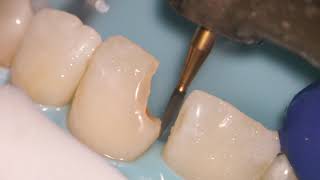 Teeth Bonding  Front tooth filling EXPLAINED [upl. by Harol]