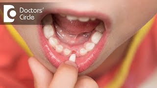 Why do childrens teeth fall out  Dr Raju Srinivas [upl. by Jackqueline]