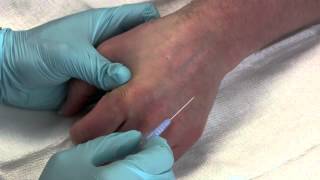 Intravenous Catheter Placement [upl. by Enitsed333]