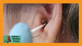 Chunky Earwax Removal  Auburn Medical Group [upl. by Nets]