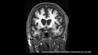 Huntingtons Disease [upl. by Anawik]