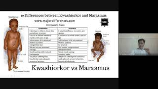 Kwashiorkor and Marasmus What’s the Difference [upl. by Kaete]