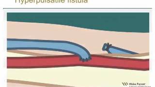 Physical Examination of Arteriovenous Fistula [upl. by Oiruam]