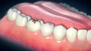 Dental Crowns Everything You Need to Know [upl. by Namad878]