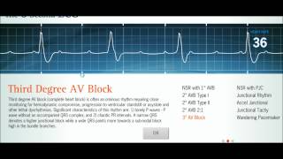 Easy EKG Interpreting Rhythms [upl. by Ahsilav]