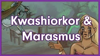 Kwashiorkor vs Marasmus  Nutrition Mnemonic [upl. by Oile]