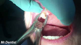 Extraction Of Molar Tooth [upl. by Eibmab188]