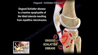 OsgoodSchlatter disease Signs symptoms and treatment options [upl. by Mureil]