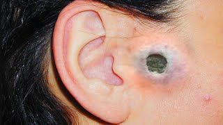 Ear and Nose Blackheads Biggest and Most Popular Comedone Extractions [upl. by Aohsoj]